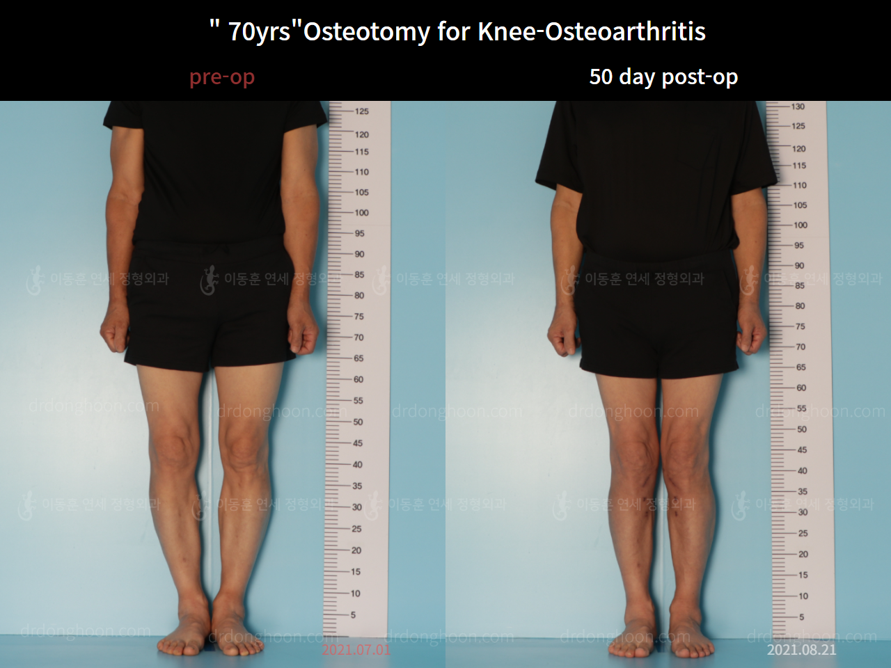 Before and after osteotomy for knee osteoarthritis, case 7753851, image 2, Dr. Donghoon institute (DALRI)