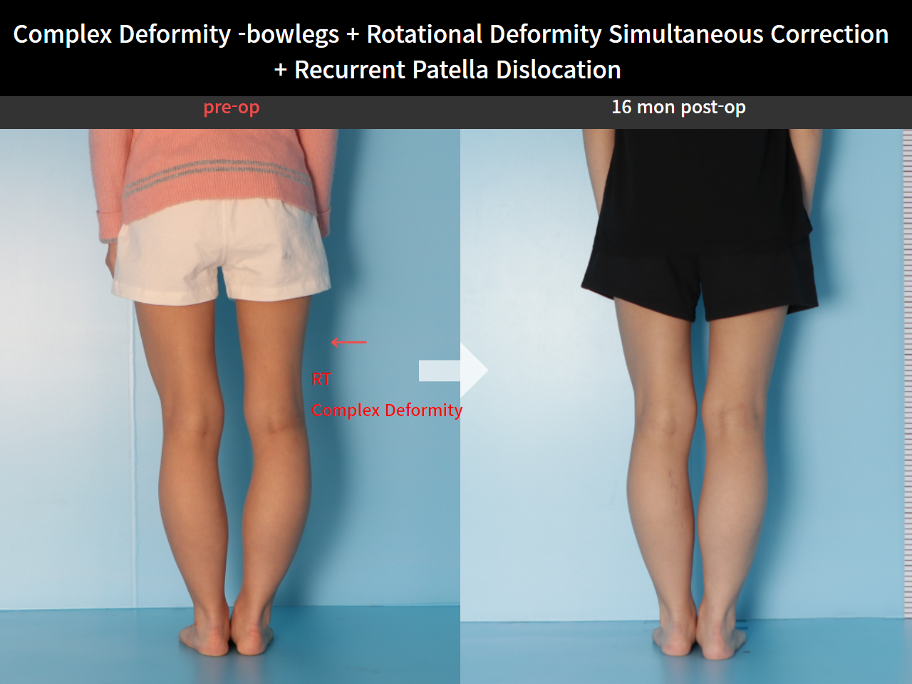 Before and after recurrent patella dislocation, case 8580605, image 6, Dr. Donghoon institute (DALRI)