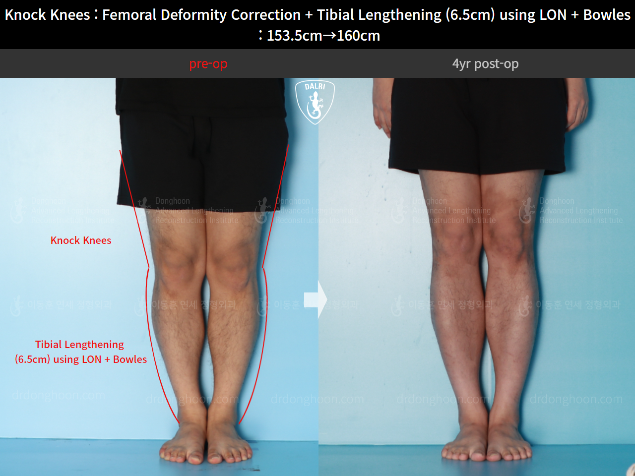 Before and after cll lon, case 16723818, image 5, Dr. Donghoon institute (DALRI)