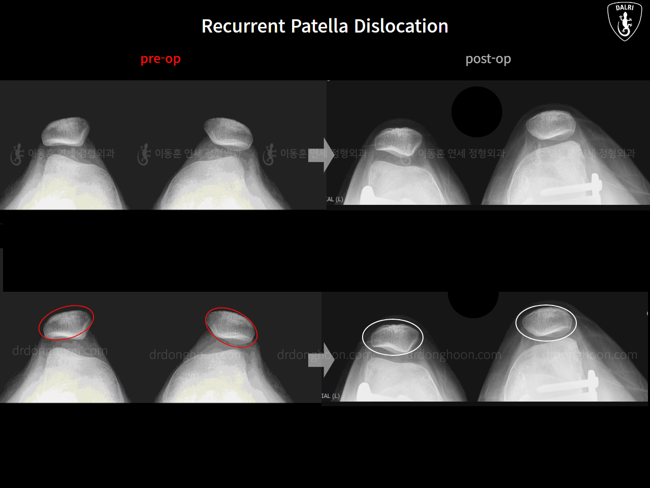 Before and after recurrent patella dislocation, case 16298897, image 10, Dr. Donghoon institute (DALRI)