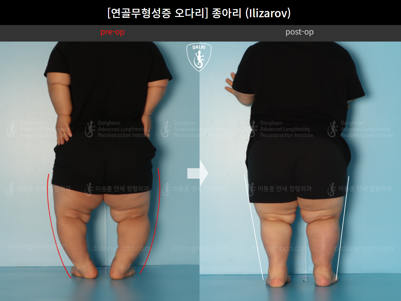 Before and after congenital condition, case 18077774, image 2, Dr. Donghoon institute (DALRI)