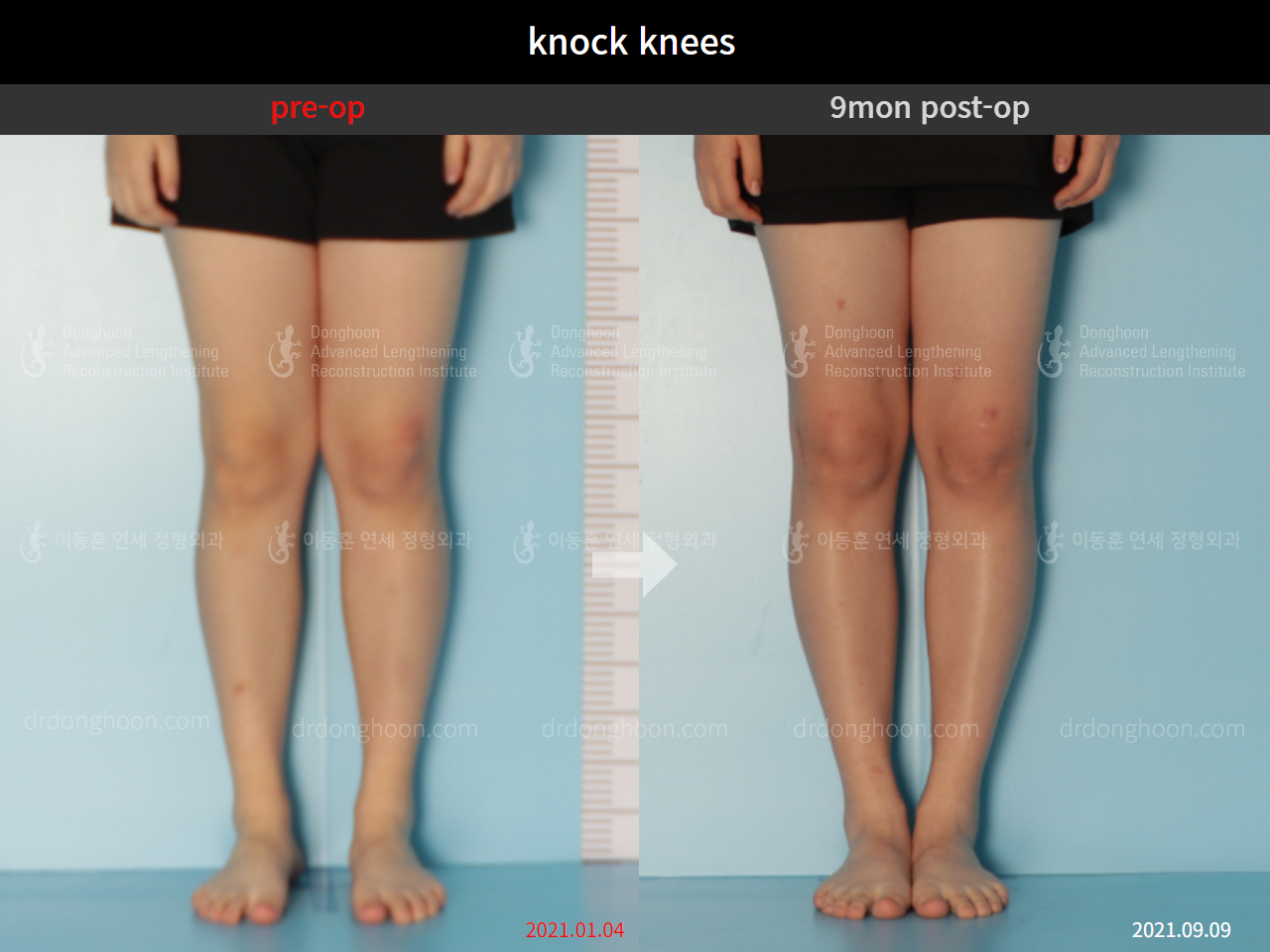 Before and after adult knock knees, case 9095996, image 3, Dr. Donghoon institute (DALRI)