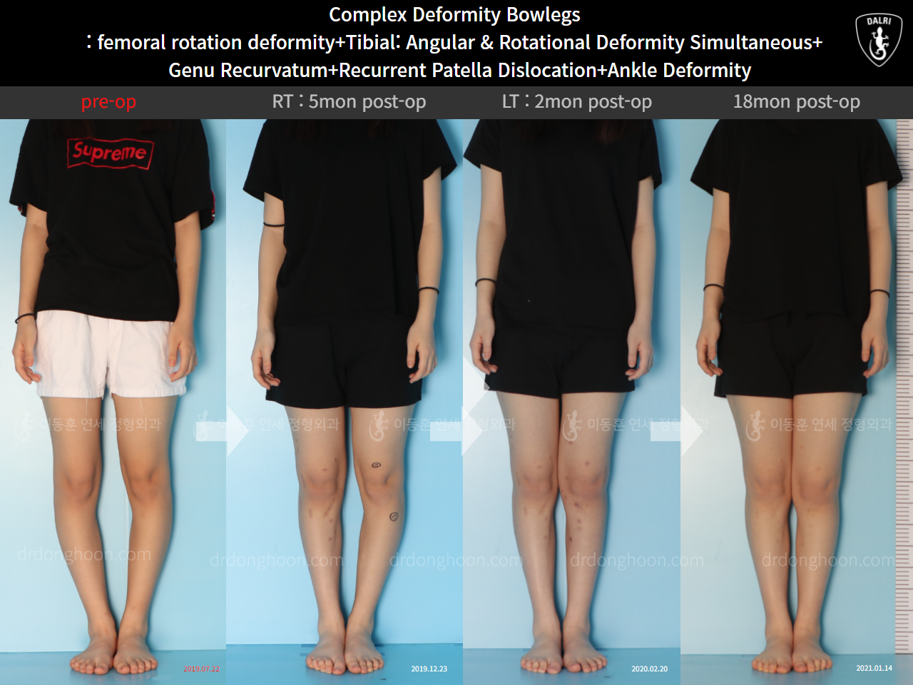 Before and after complex deformity, case 11244013, image 1, Dr. Donghoon institute (DALRI)