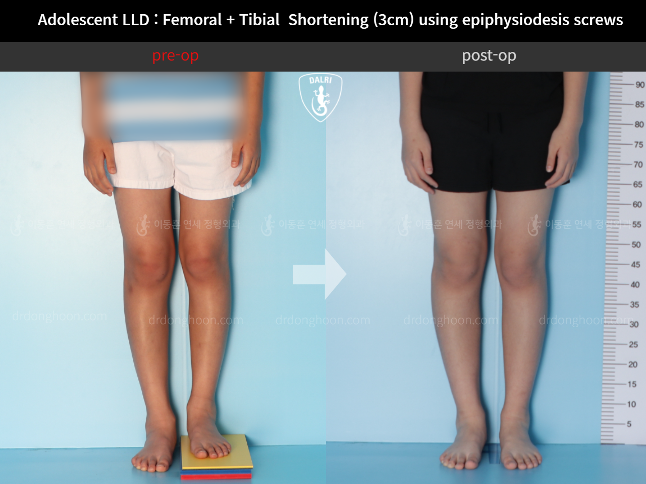 Before and after paediatric & adolescent lld, case 11511257, image 3, Dr. Donghoon institute (DALRI)