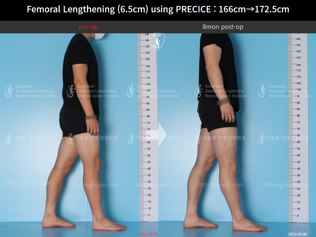 Before and after cll precice, case 14706614, image 7, Dr. Donghoon institute (DALRI)
