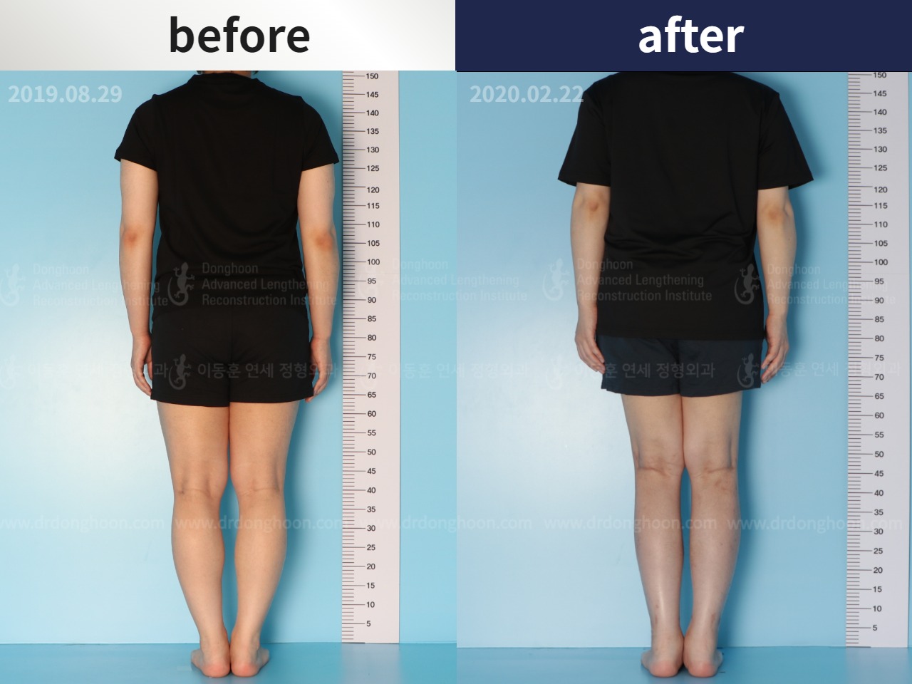 Before and after cll lon, case 4577808, image 2, Dr. Donghoon institute (DALRI)