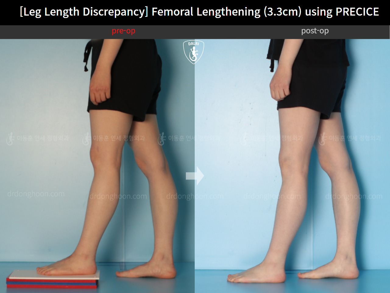 Before and after adult lld, case 22355841, image 8, Dr. Donghoon institute (DALRI)