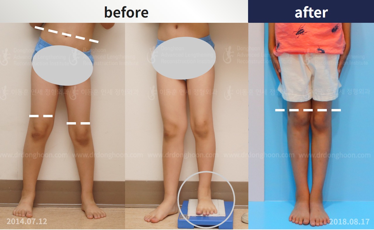 Before and after paediatric & adolescent lld, case 4320426, image 1, Dr. Donghoon institute (DALRI)