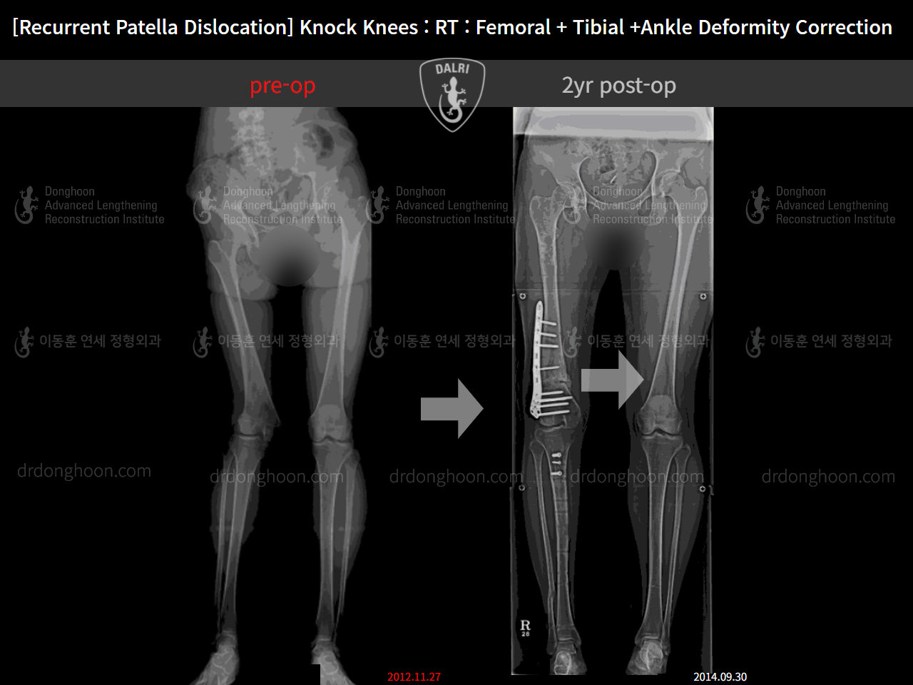 Before and after adult knock knees, case 10780541, image 3, Dr. Donghoon institute (DALRI)