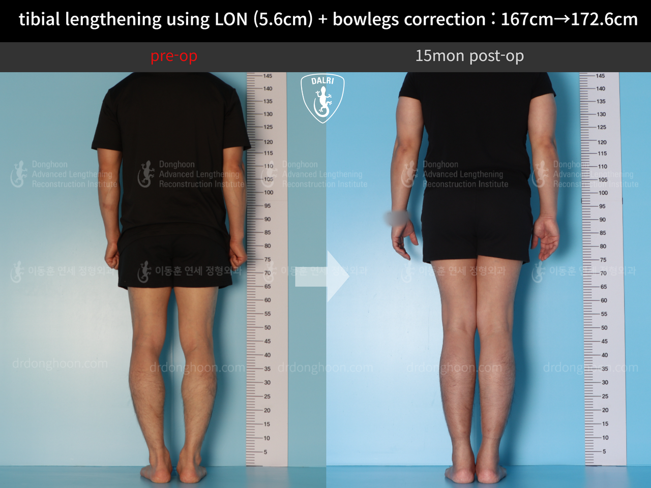 Before and after cll + deformity correction, case 12804946, image 2, Dr. Donghoon institute (DALRI)