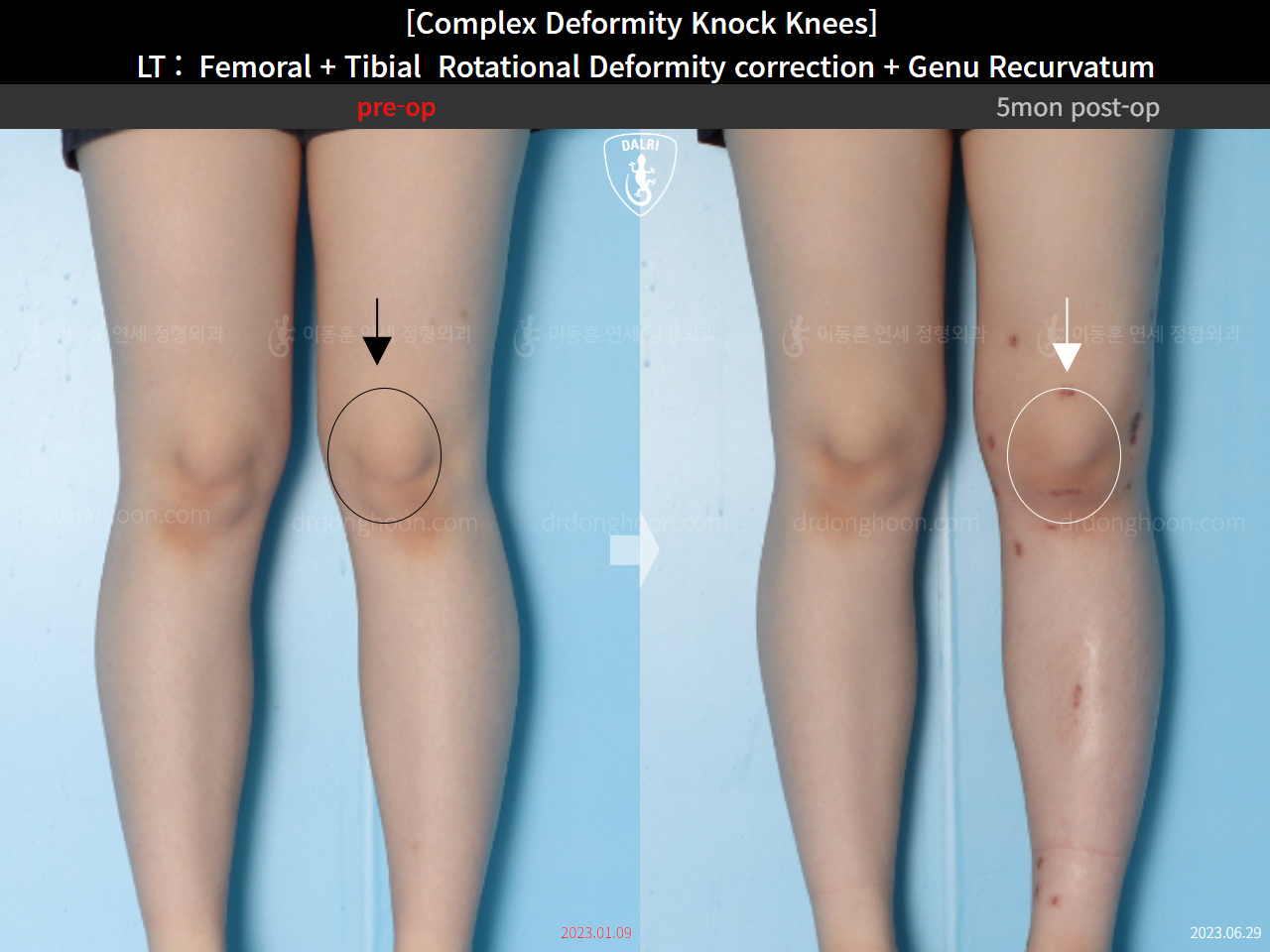 Before and after genu recurvatum, case 16212778, image 11, Dr. Donghoon institute (DALRI)