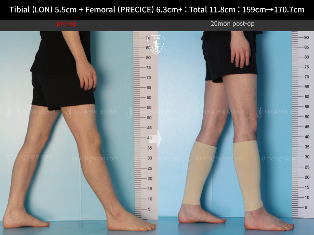 Before and after cll lon, case 14390077, image 10, Dr. Donghoon institute (DALRI)