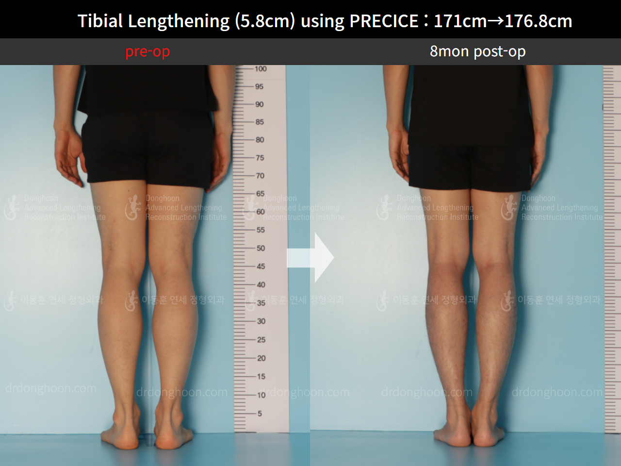 Before and after cll precice, case 8678696, image 6, Dr. Donghoon institute (DALRI)