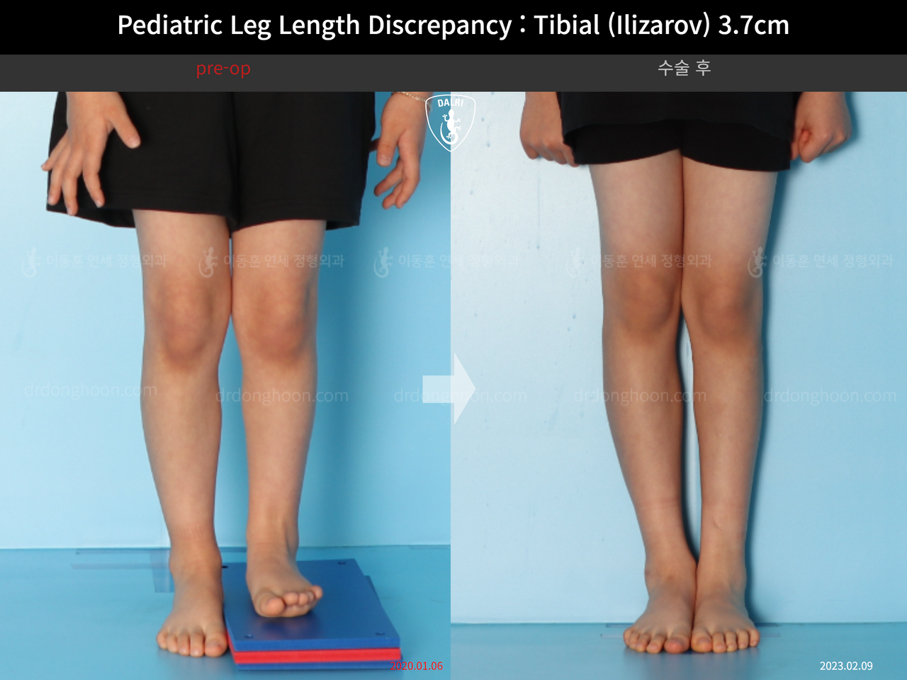 Before and after paediatric & adolescent lld, case 14220900, image 5, Dr. Donghoon institute (DALRI)