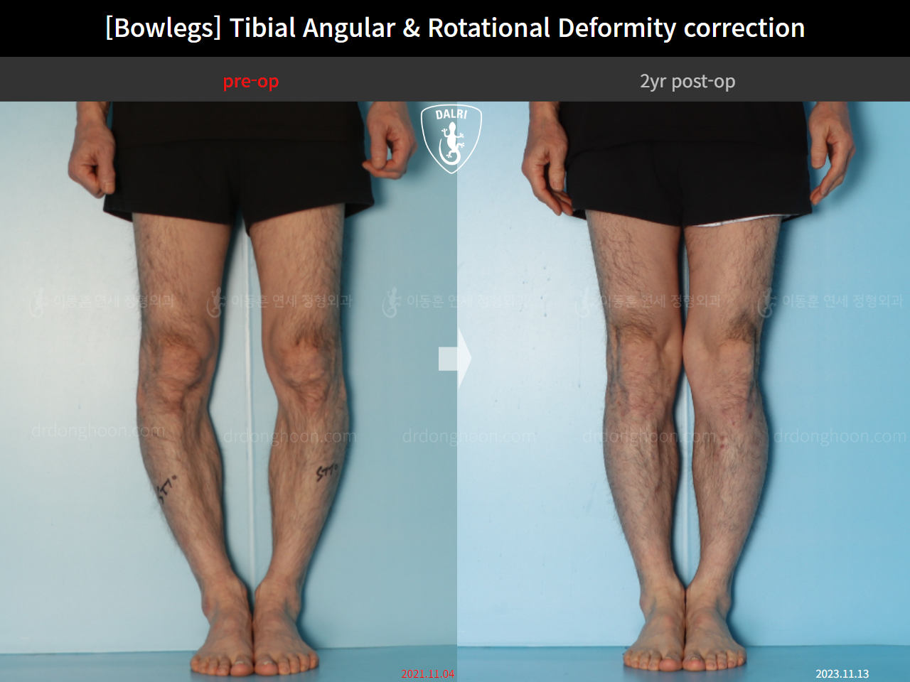 Before and after adult bowlegs, case 16933272, image 5, Dr. Donghoon institute (DALRI)