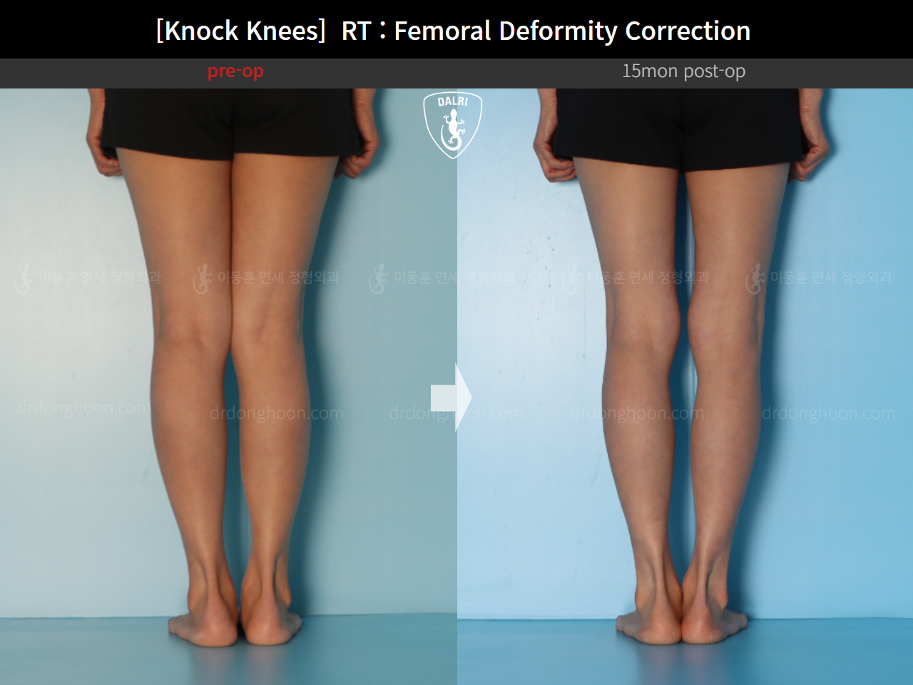 Before and after adult knock knees, case 14462642, image 8, Dr. Donghoon institute (DALRI)