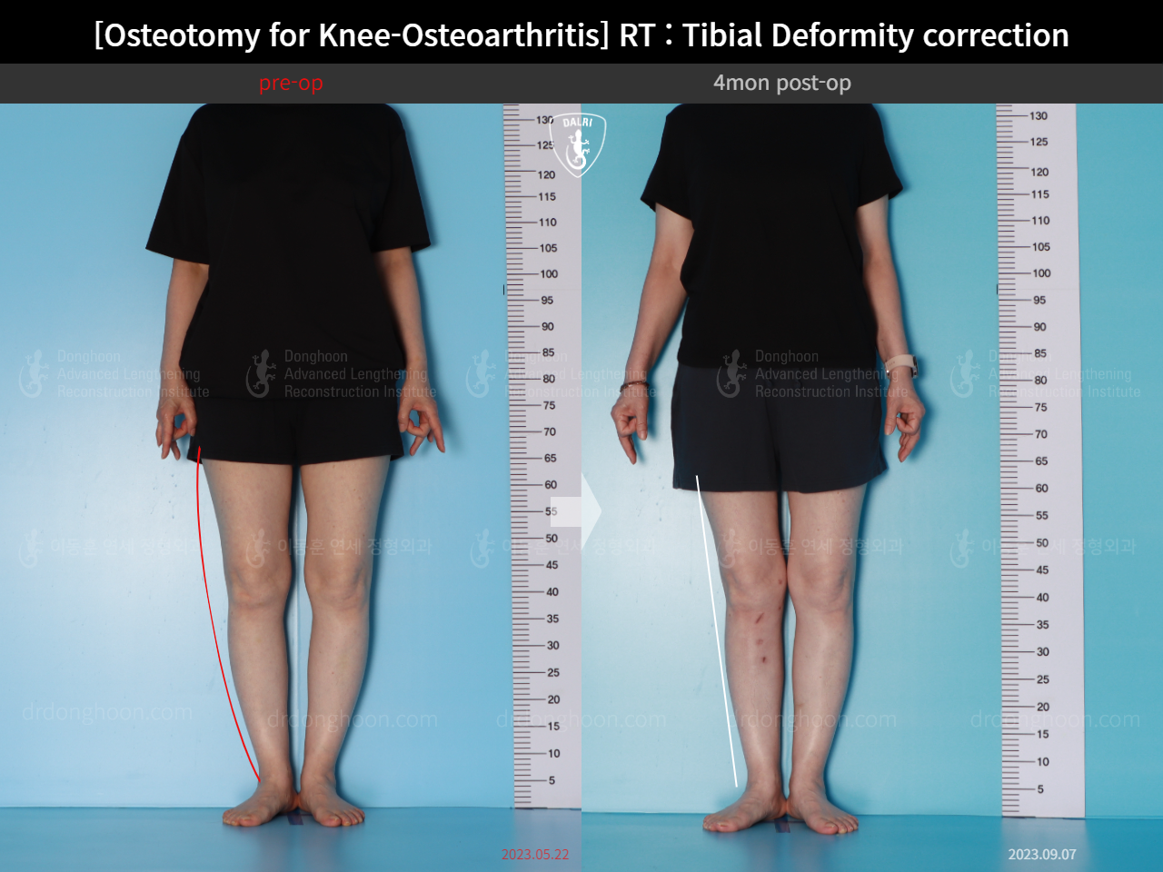 Before and after osteotomy for knee osteoarthritis, case 17890677, image 2, Dr. Donghoon institute (DALRI)