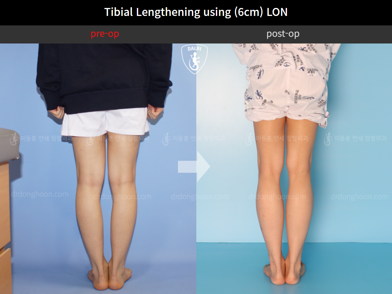 Before and after cll lon, case 4577694, image 6, Dr. Donghoon institute (DALRI)