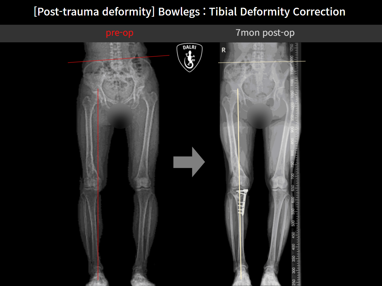 Before and after osteotomy for knee osteoarthritis, case 10389290, image 6, Dr. Donghoon institute (DALRI)