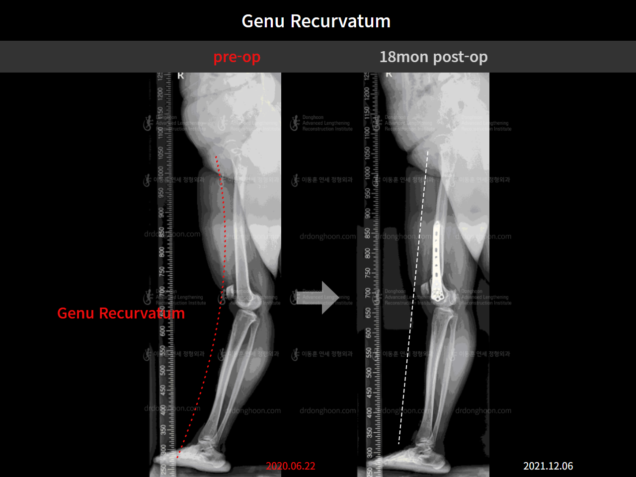 Before and after genu recurvatum, case 5656817, image 4, Dr. Donghoon institute (DALRI)