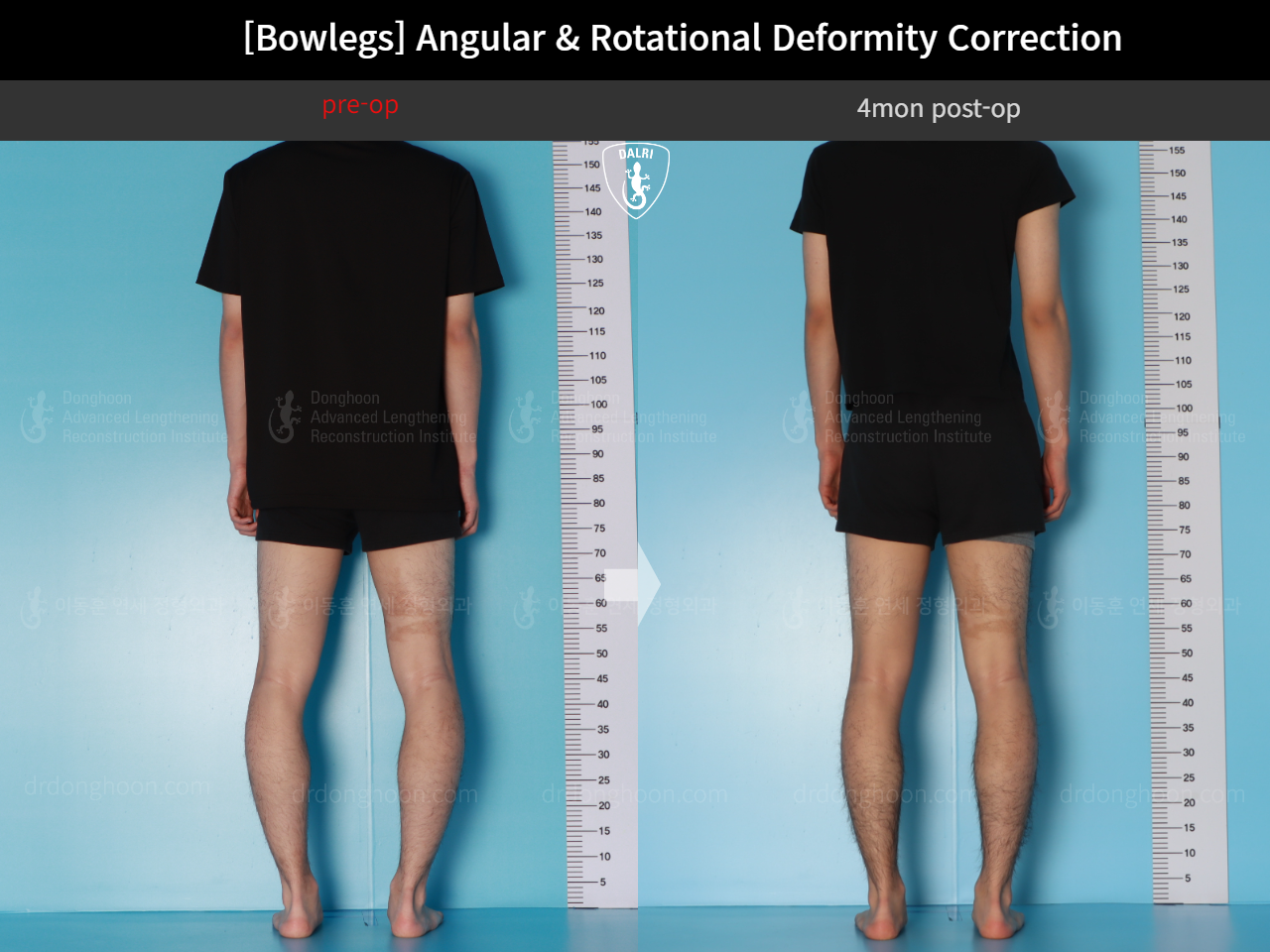 Before and after adult bowlegs, case 18071382, image 5, Dr. Donghoon institute (DALRI)