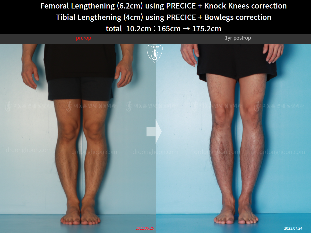 Before and after cll + deformity correction, case 15903252, image 9, Dr. Donghoon institute (DALRI)