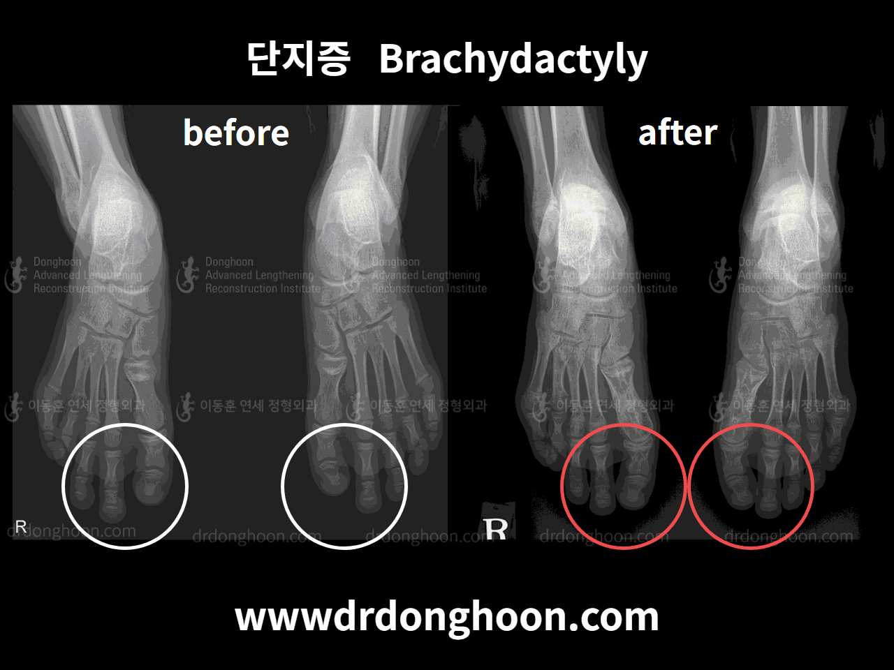 Before and after brachymetatarsia, case 4249076, image 1, Dr. Donghoon institute (DALRI)