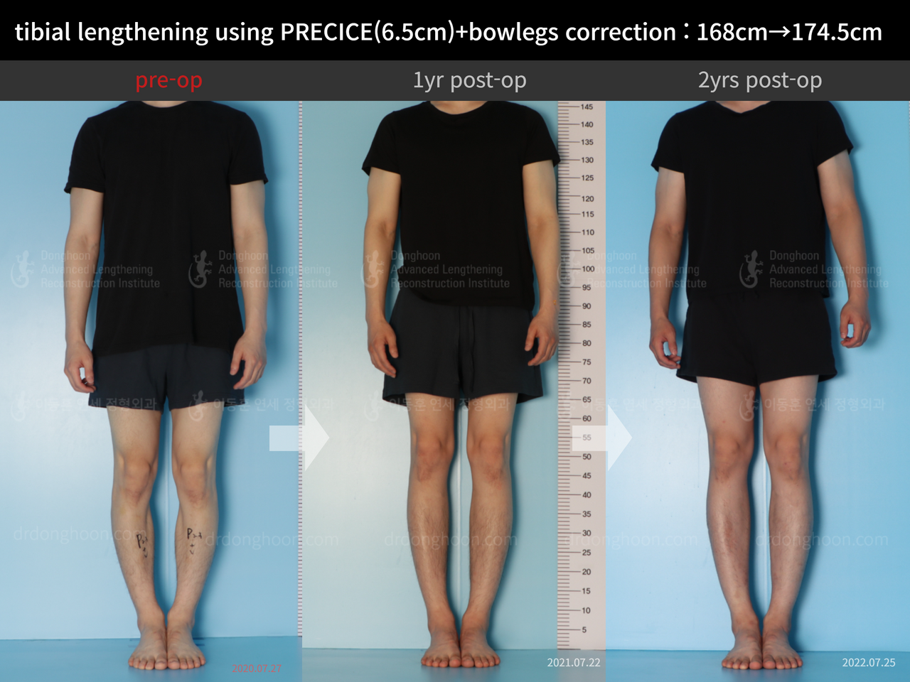 Before and after cll + deformity correction, case 12410003, image 2, Dr. Donghoon institute (DALRI)