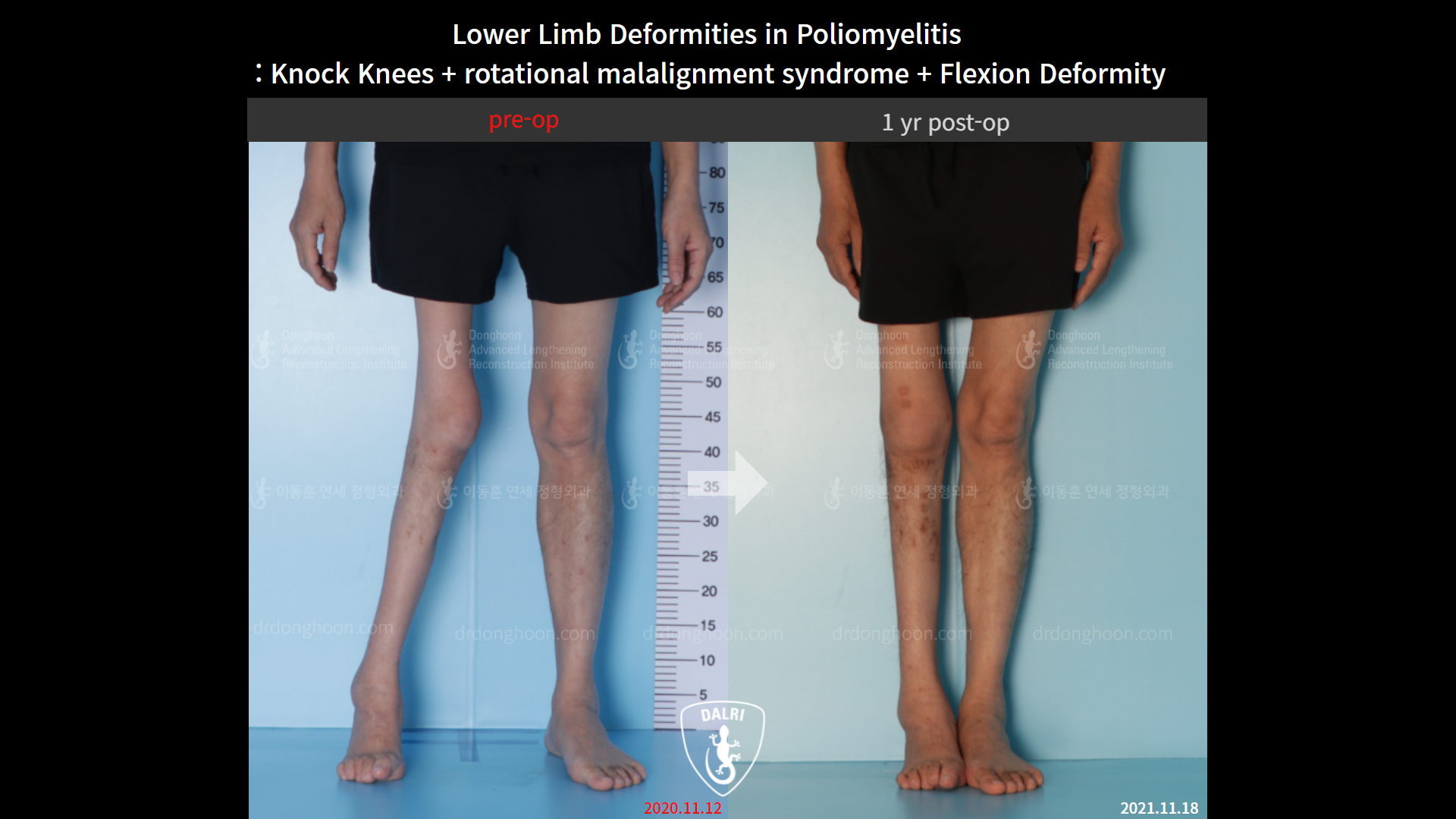 Before and after adult knock knees, case 9154930, image 3, Dr. Donghoon institute (DALRI)