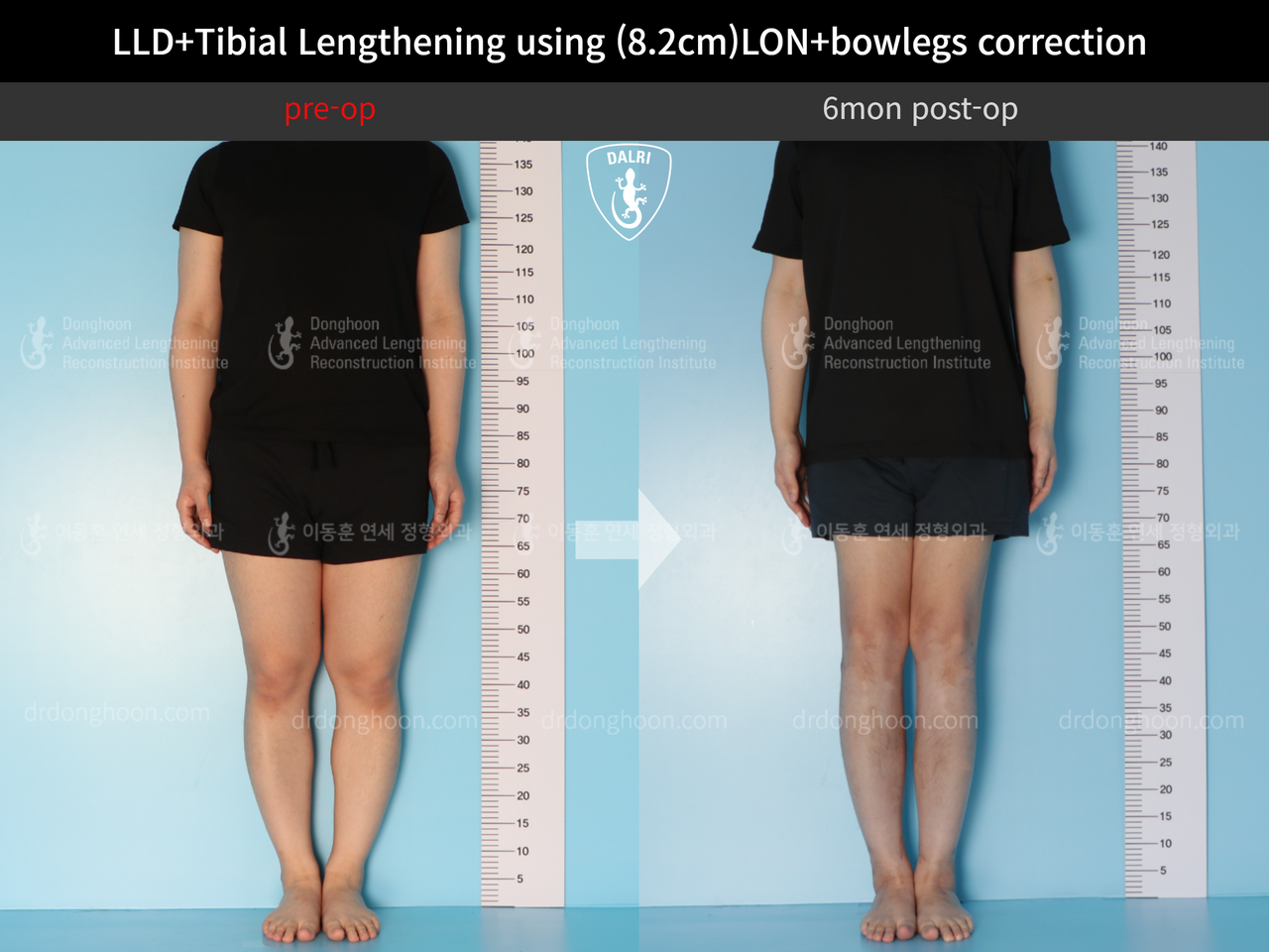 Before and after cll + deformity correction, case 12782230, image 1, Dr. Donghoon institute (DALRI)