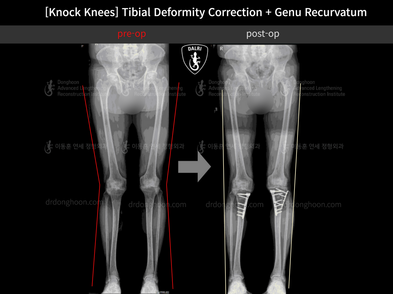 Before and after adult knock knees, case 12846255, image 9, Dr. Donghoon institute (DALRI)