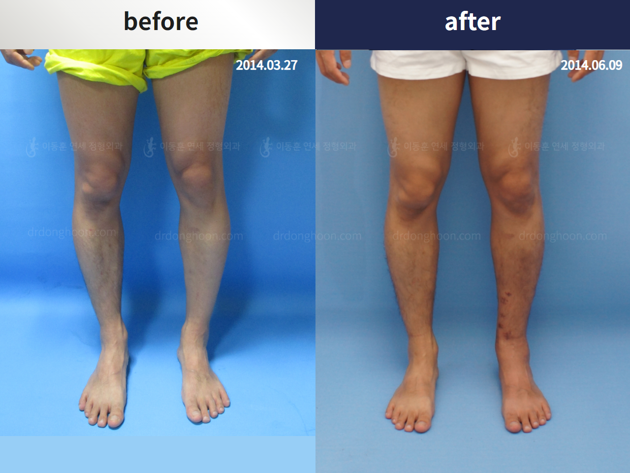 Before and after foot & ankle deformity, case 4246372, image 3, Dr. Donghoon institute (DALRI)