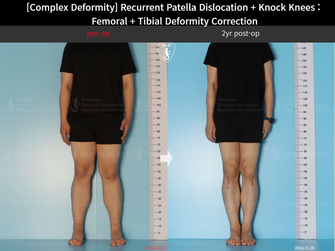 Before and after recurrent patella dislocation, case 17434915, image 1, Dr. Donghoon institute (DALRI)
