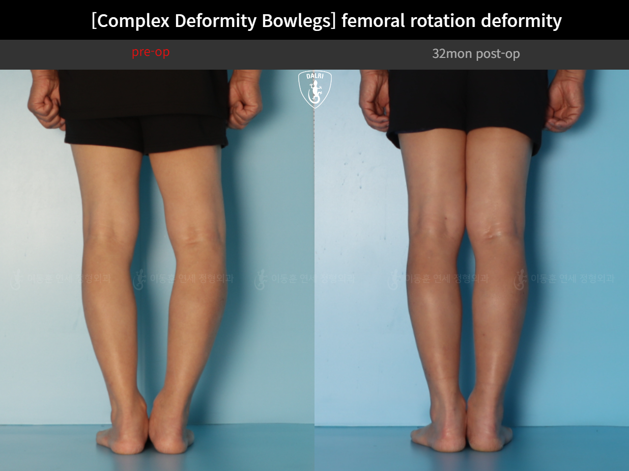 Before and after adult bowlegs, case 35242887, image 12, Dr. Donghoon institute (DALRI)