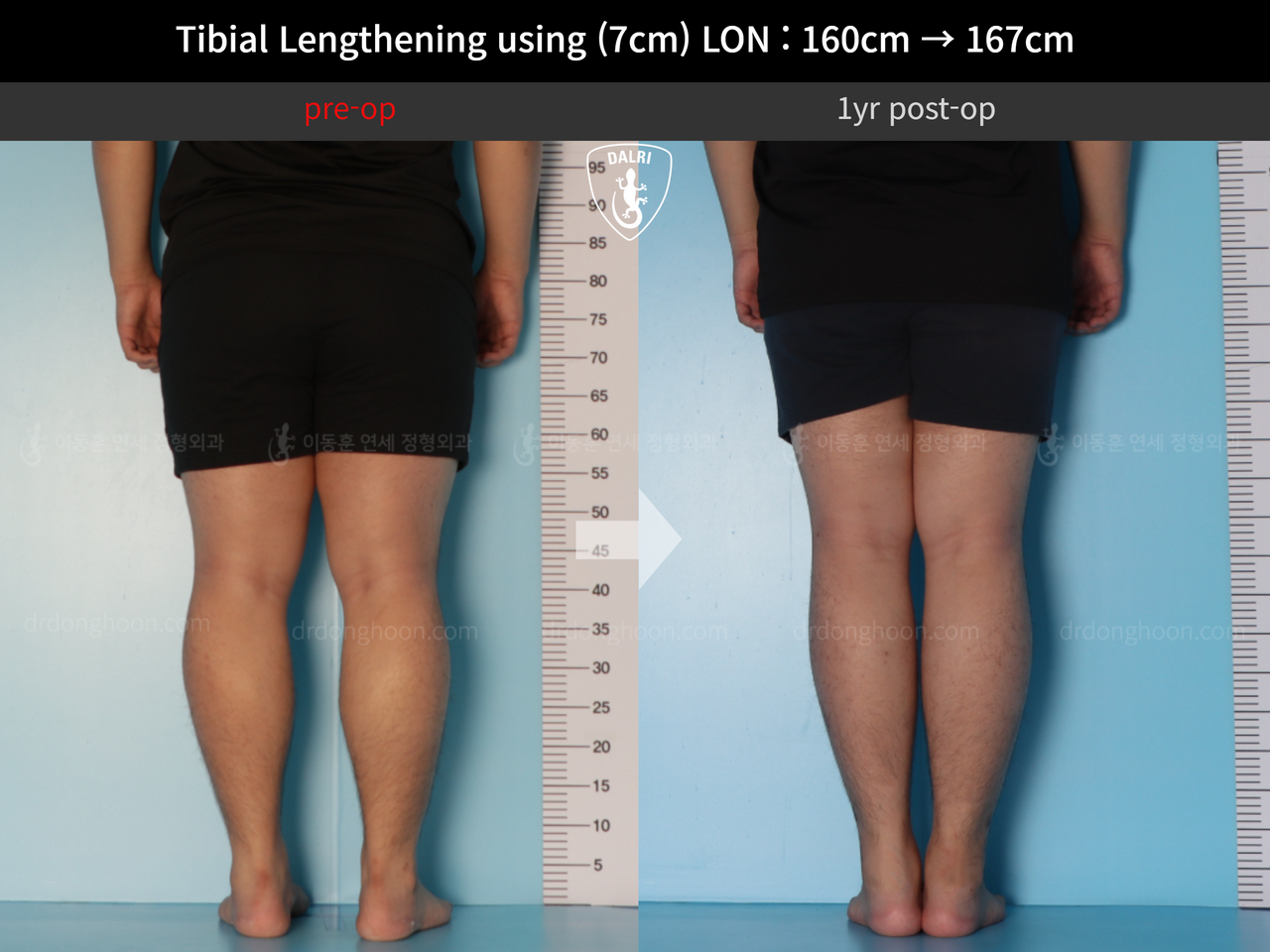 Before and after cll lon, case 12395704, image 6, Dr. Donghoon institute (DALRI)