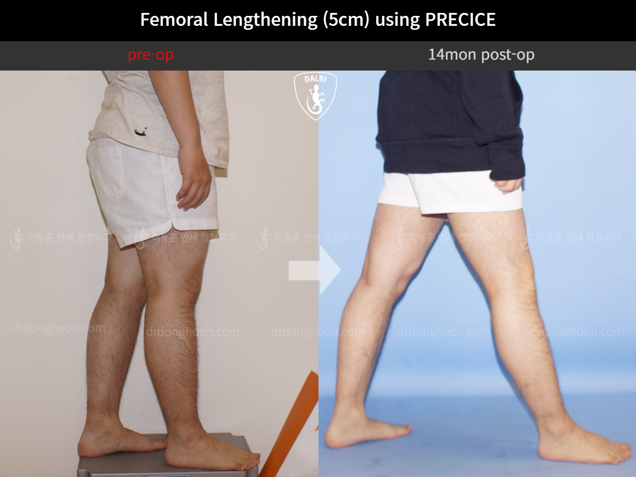 Before and after cll precice, case 4323249, image 7, Dr. Donghoon institute (DALRI)
