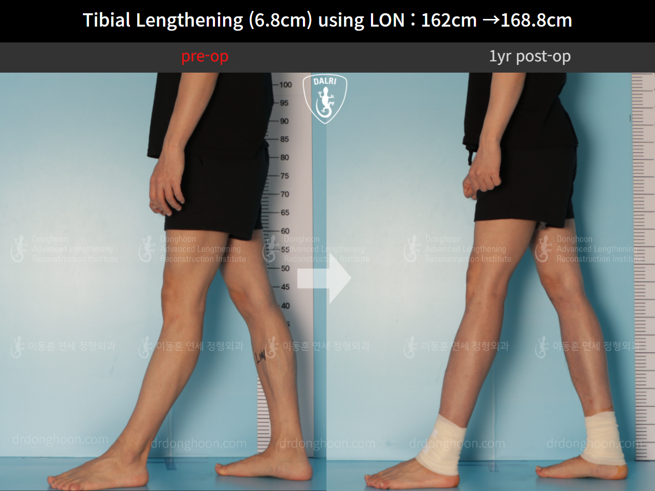 Before and after cll lon, case 10294551, image 8, Dr. Donghoon institute (DALRI)