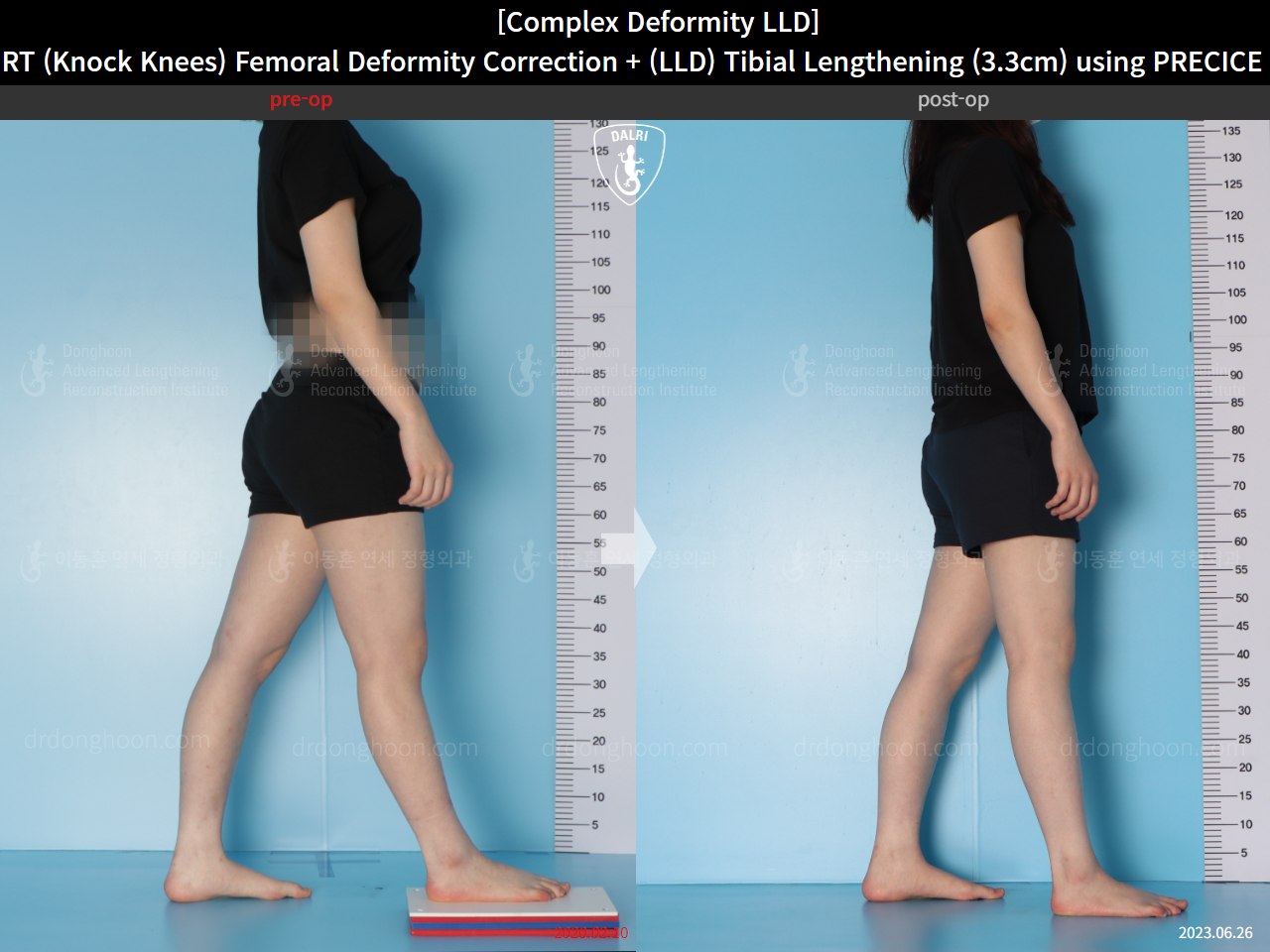 Before and after adult lld, case 15584036, image 4, Dr. Donghoon institute (DALRI)