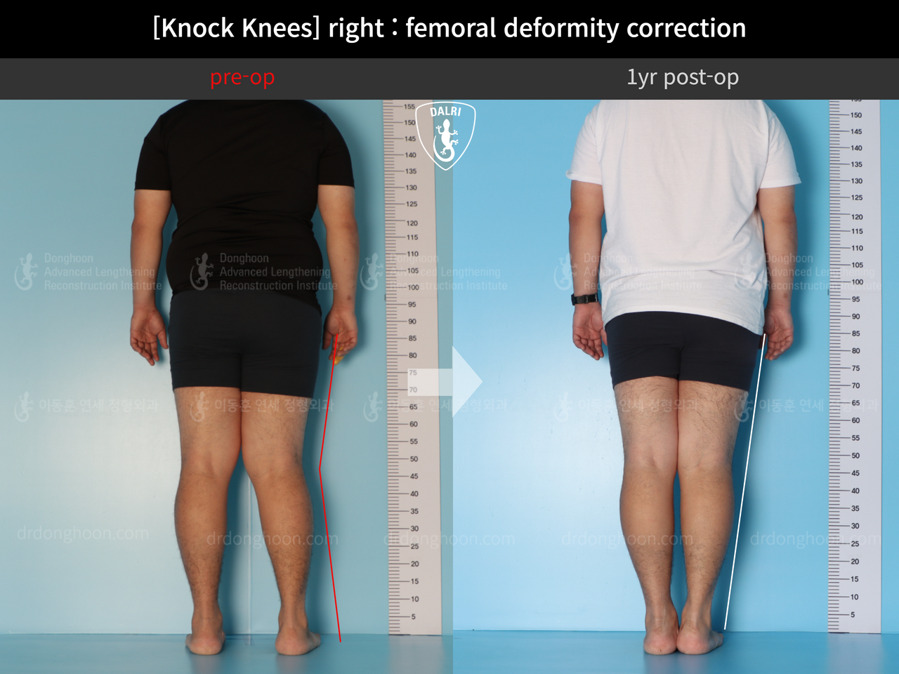 Before and after adult knock knees, case 13582115, image 2, Dr. Donghoon institute (DALRI)