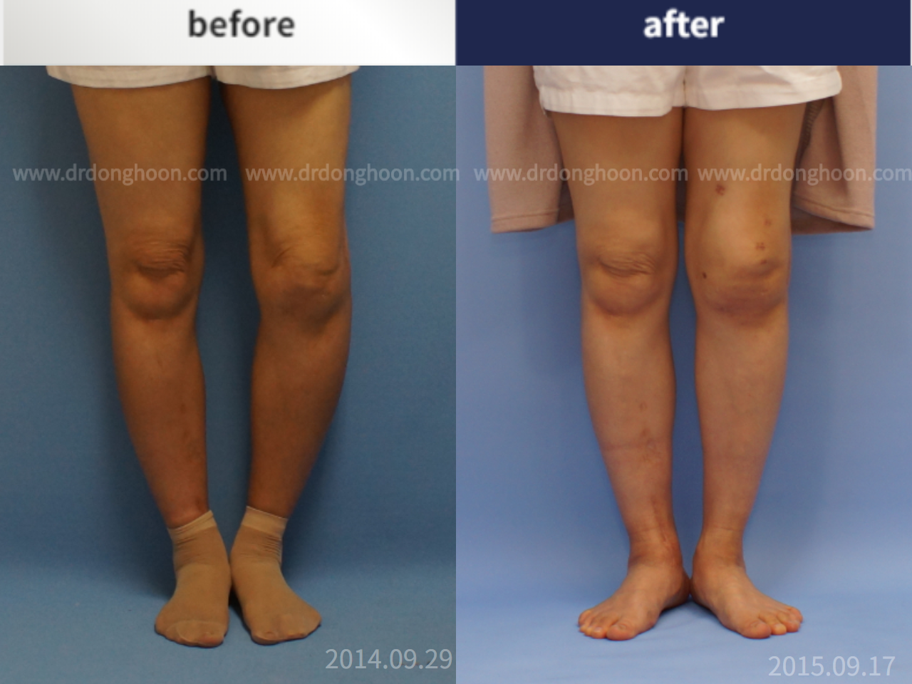 Before and after post-trauma deformity, case 4251782, image 2, Dr. Donghoon institute (DALRI)