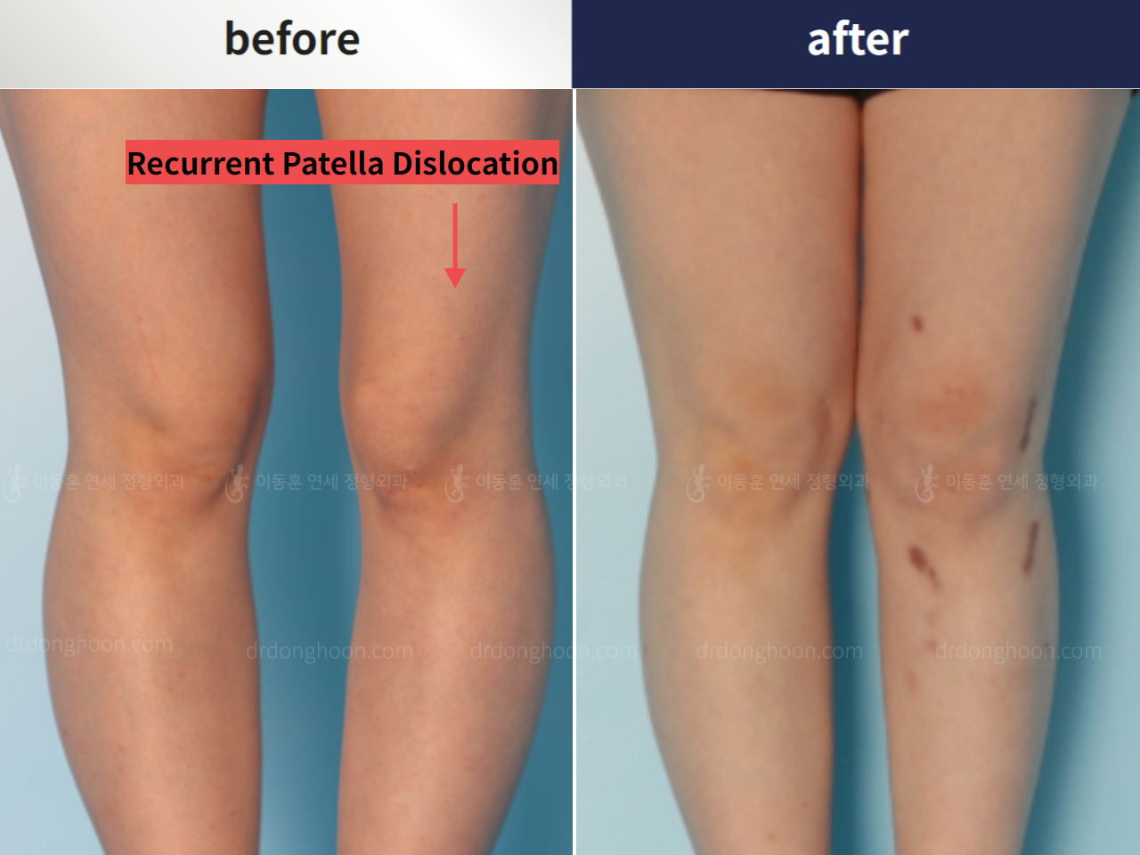 Before and after recurrent patella dislocation, case 5456889, image 2, Dr. Donghoon institute (DALRI)