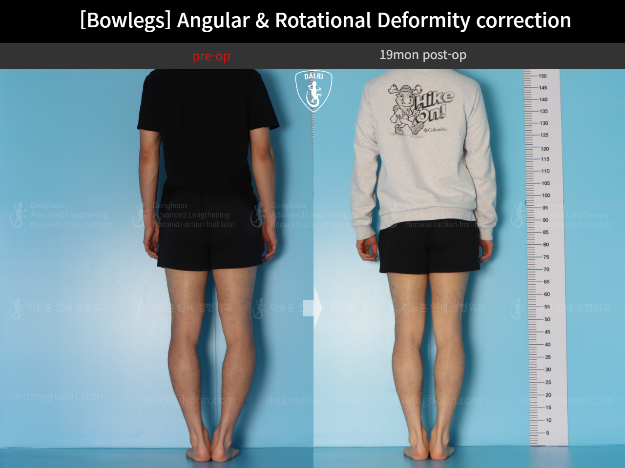 Before and after adult bowlegs, case 18306379, image 5, Dr. Donghoon institute (DALRI)