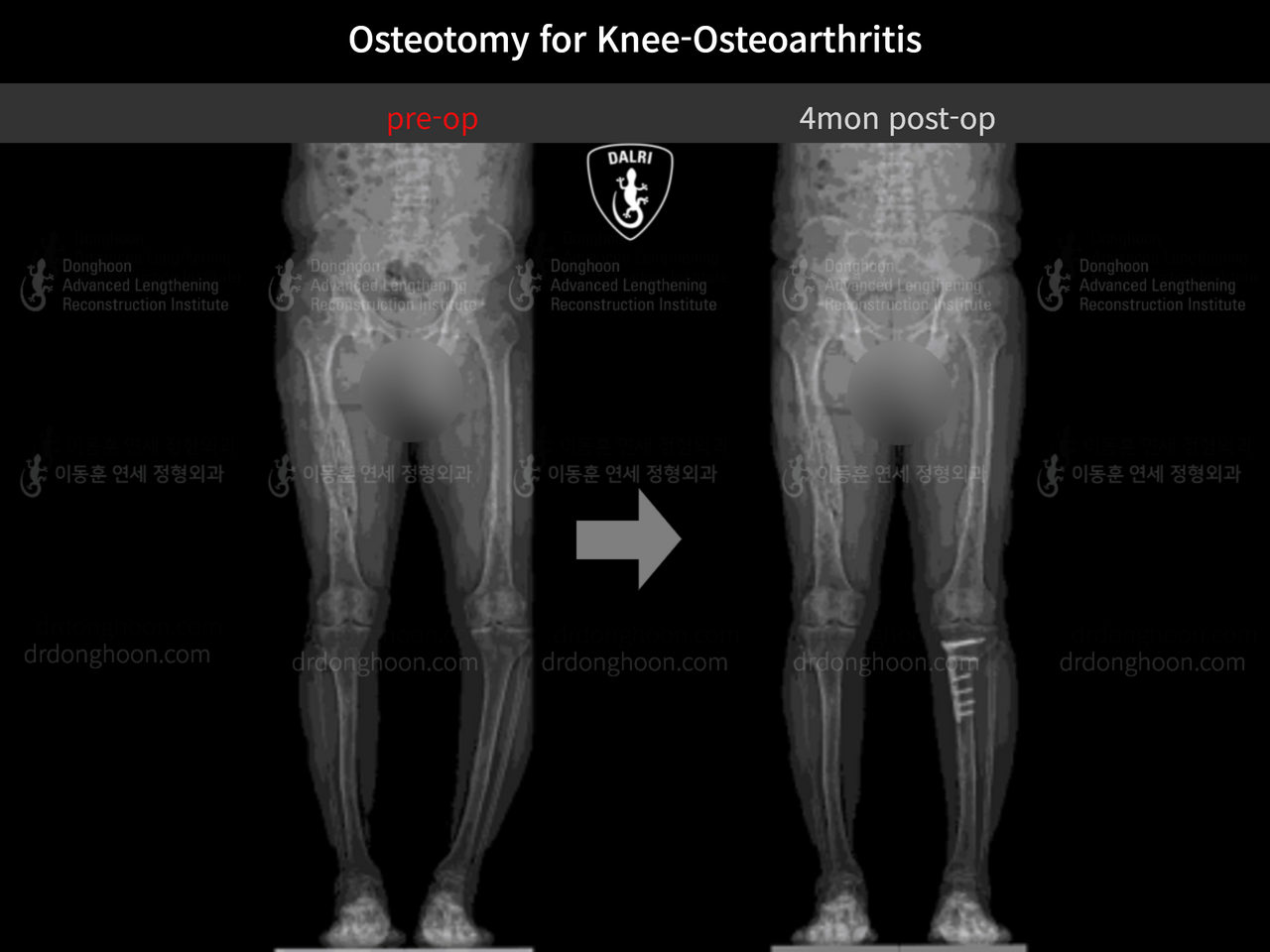 Before and after osteotomy for knee osteoarthritis, case 12535590, image 8, Dr. Donghoon institute (DALRI)