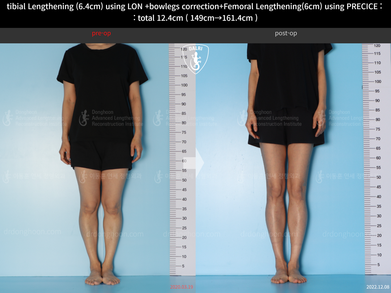 Before and after cll + deformity correction, case 13696242, image 5, Dr. Donghoon institute (DALRI)
