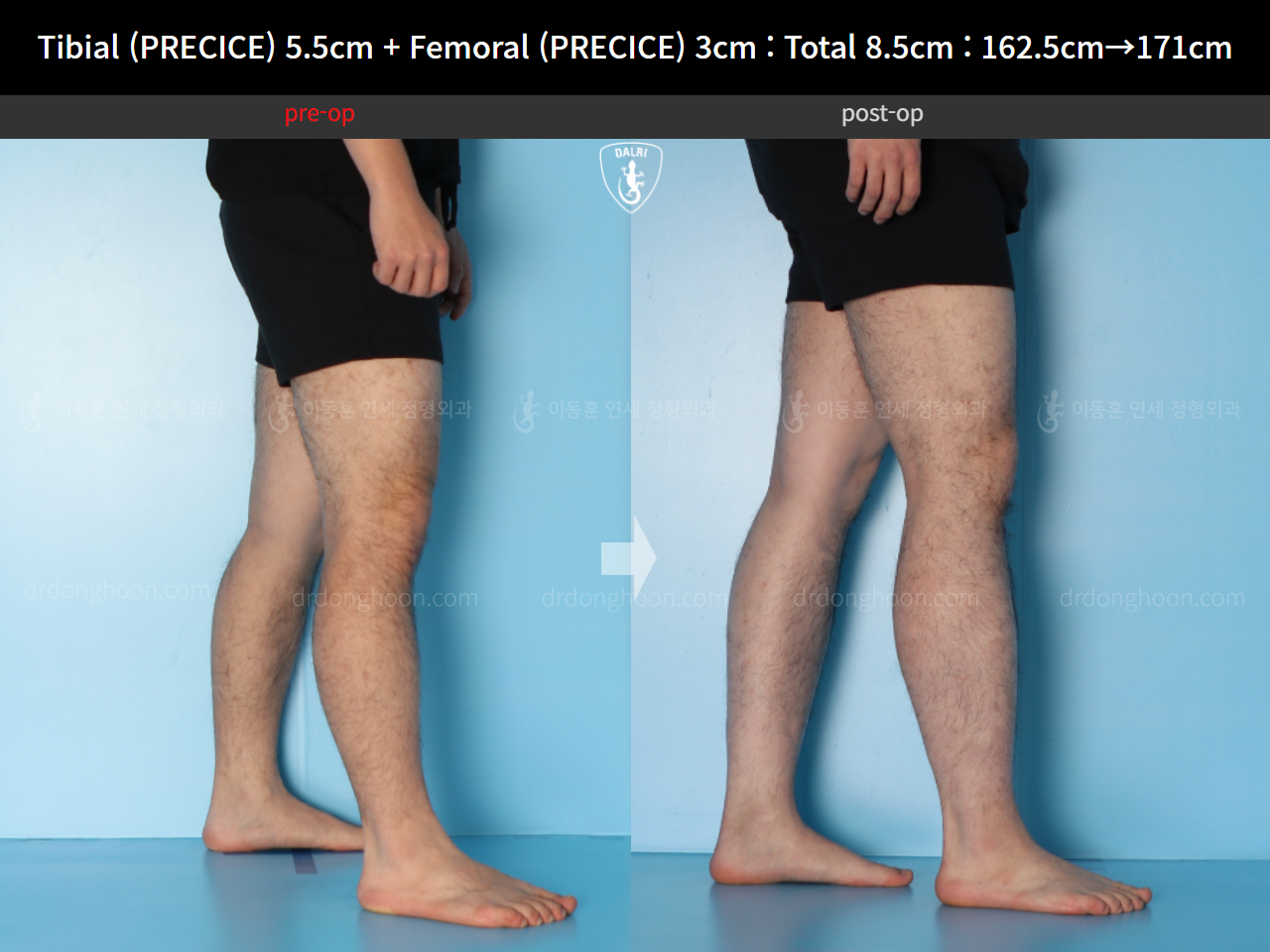 Before and after cll precice, case 15140008, image 7, Dr. Donghoon institute (DALRI)