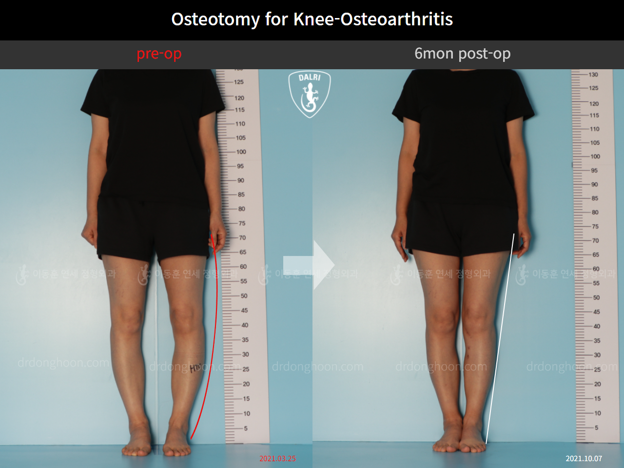 Before and after osteotomy for knee osteoarthritis, case 10451826, image 1, Dr. Donghoon institute (DALRI)