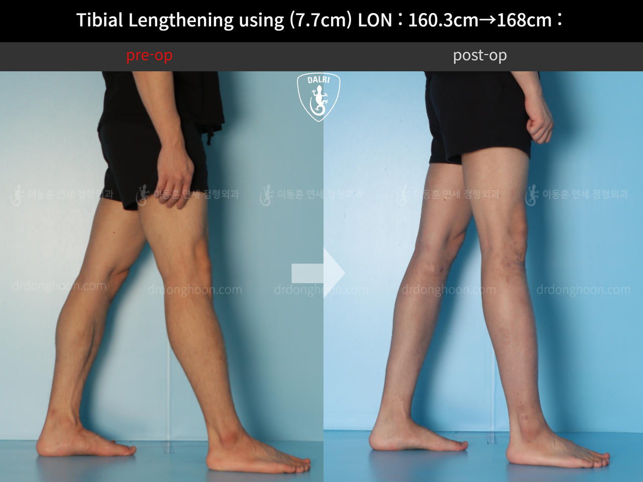 Before and after cll lon, case 12643440, image 7, Dr. Donghoon institute (DALRI)