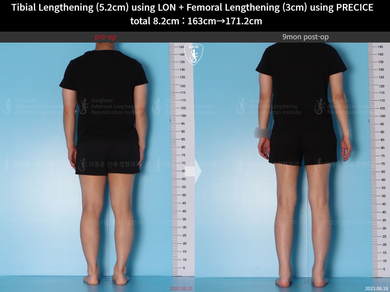 Before and after cll precice, case 15203330, image 5, Dr. Donghoon institute (DALRI)