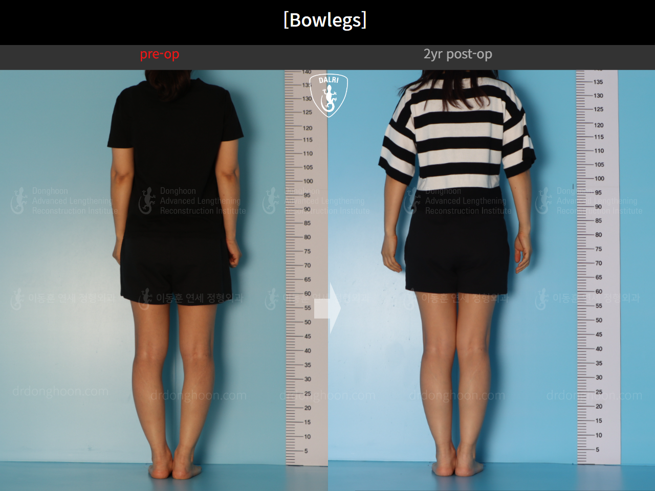 Before and after adult bowlegs, case 20942169, image 4, Dr. Donghoon institute (DALRI)