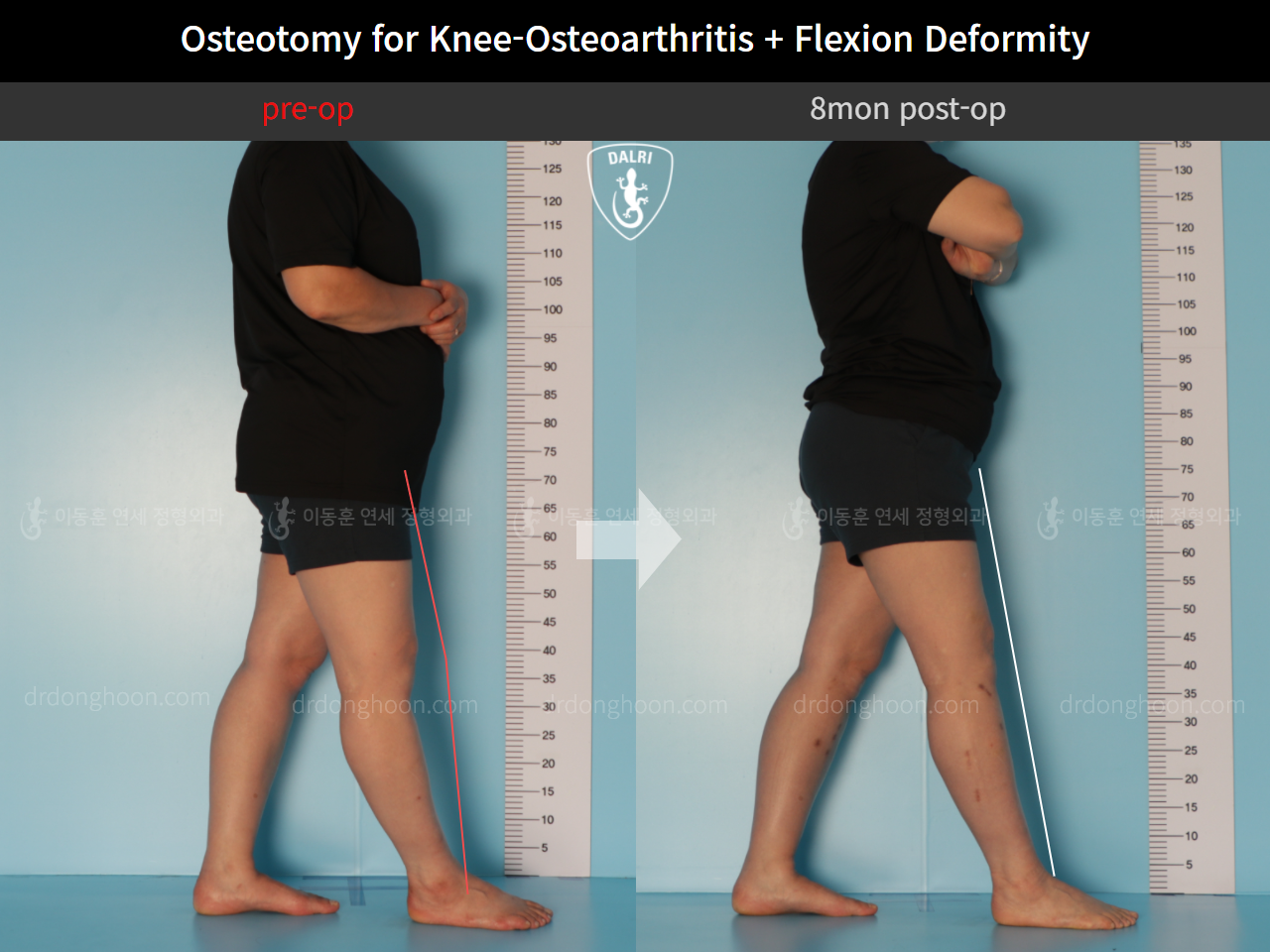 Before and after osteotomy for knee osteoarthritis, case 10663581, image 3, Dr. Donghoon institute (DALRI)